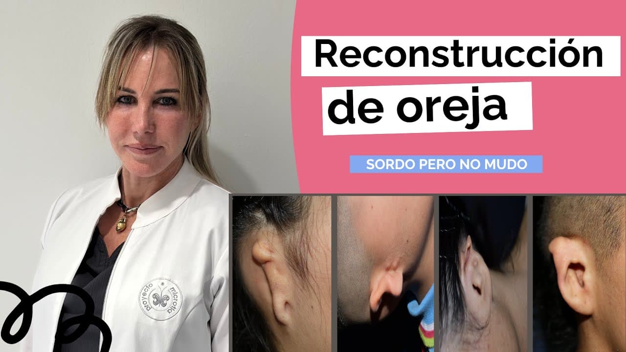 Reconstrucción Estética de Oreja - Proyecto Microtia - Dra Fernanda Valotta
